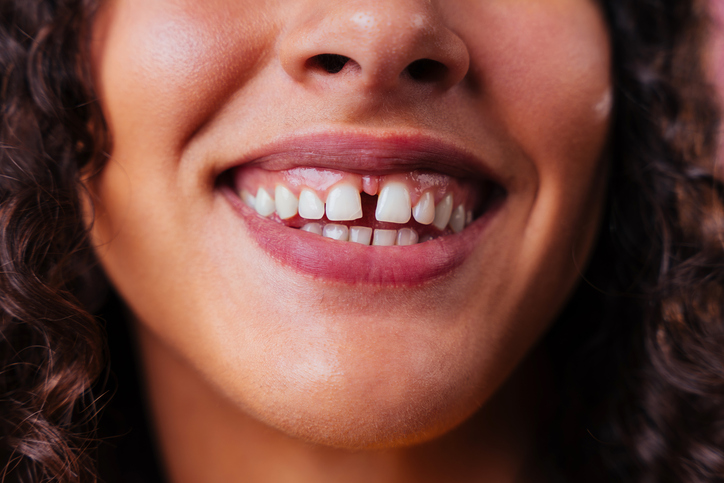 Los dientes separados, o diastema, son un espacio notable entre dos dientes.