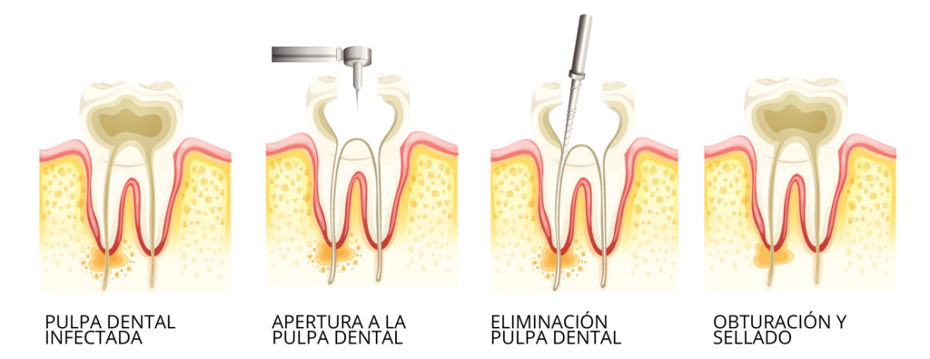 fases-endodoncia