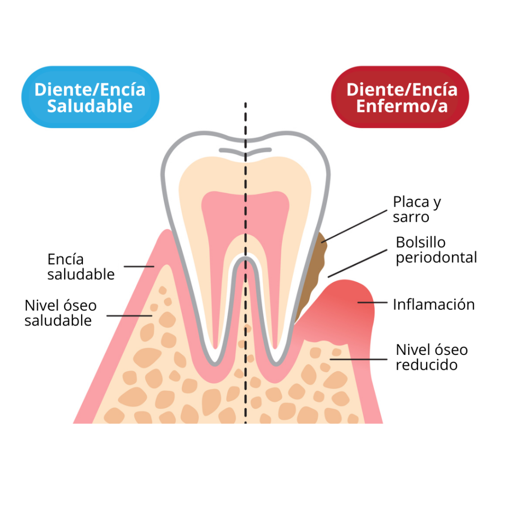 cirugia periodontal