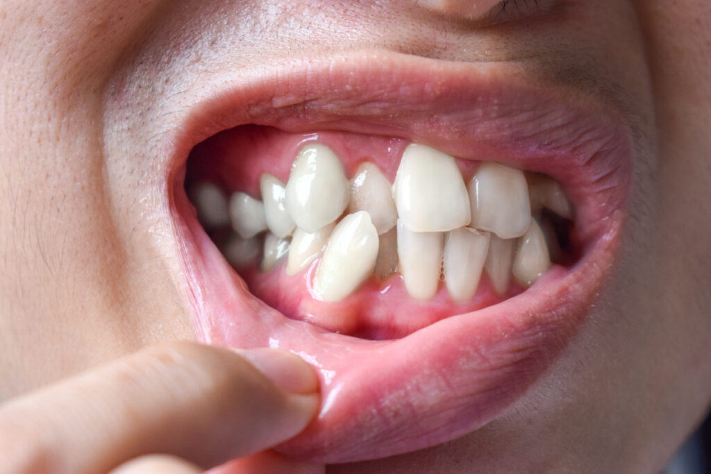 dientes torcidos