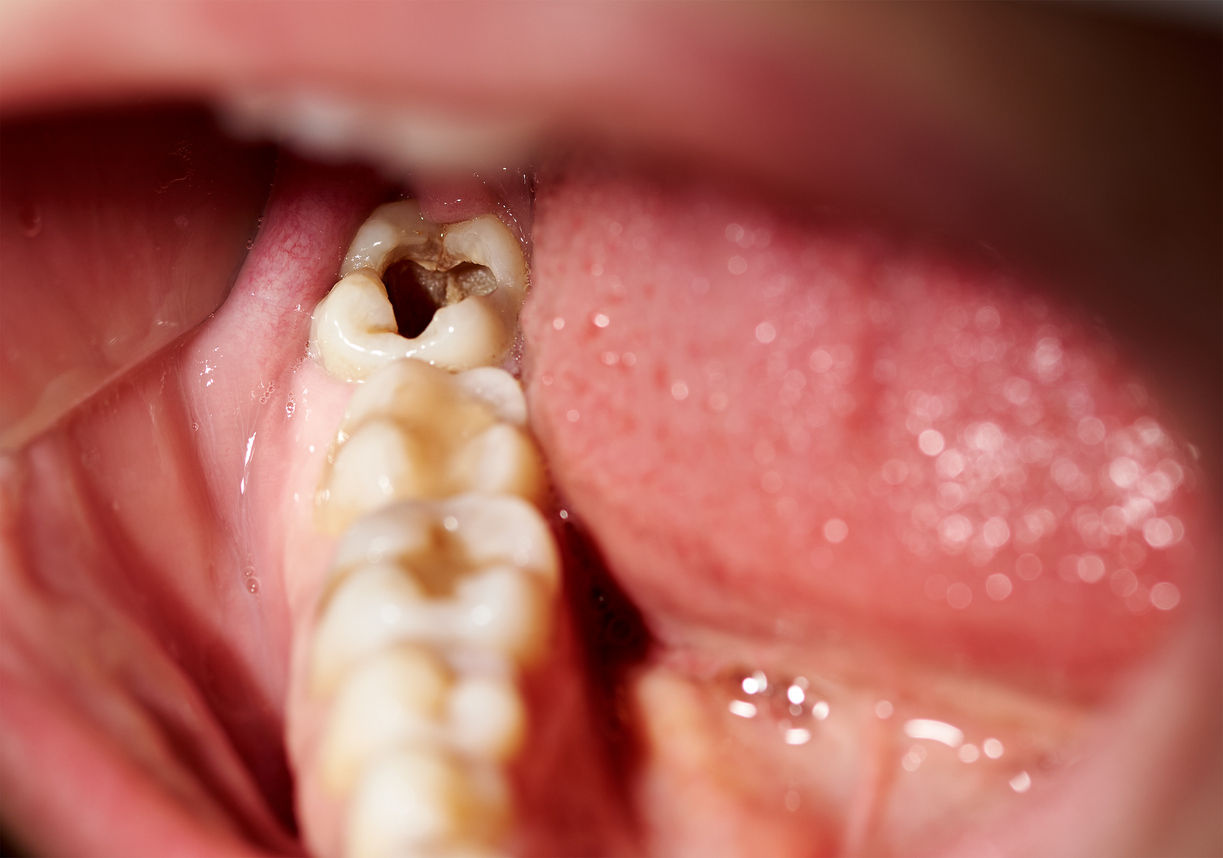 como prevenir caries