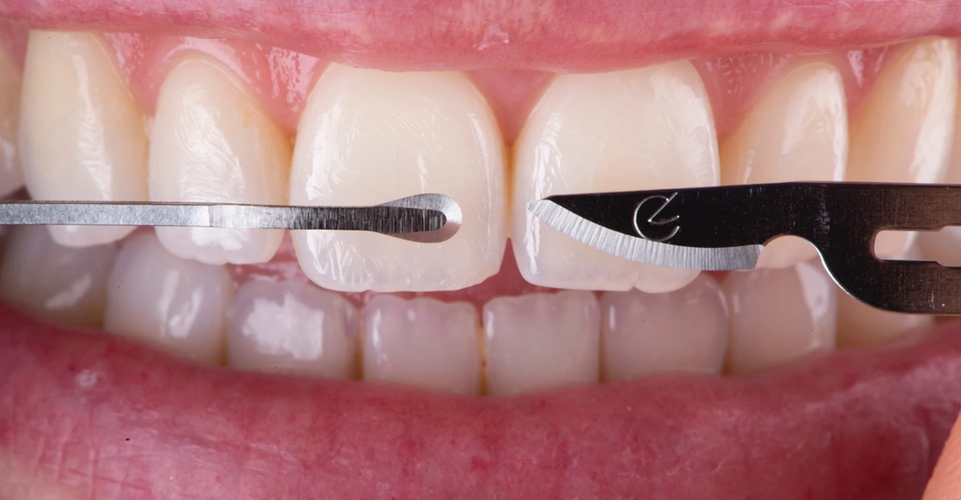 Microcirugía plástica periodontal estética